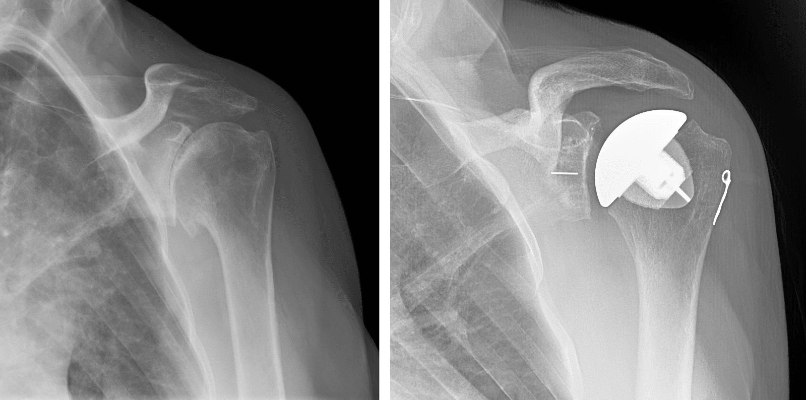 Radiographs before and after anatomic total shoulder arthroplasty