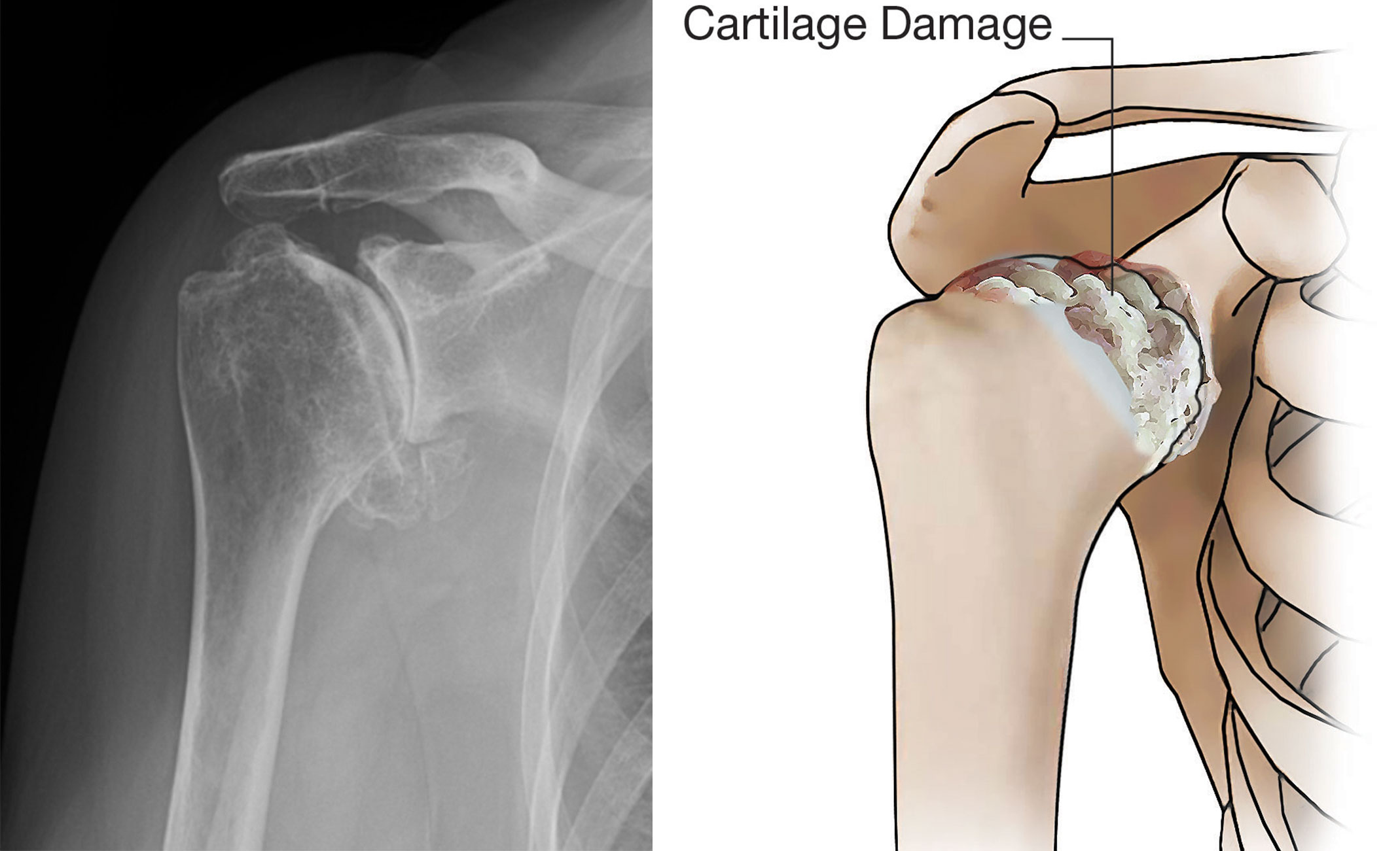 X-ray and illustration of glenohumeral osteoarthritis with cartilage damage