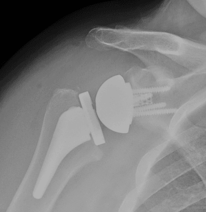Radiograph after reverse total shoulder arthroplasty showing glenosphere and humeral socket component