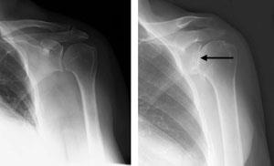 Comparison X-rays of a normal shoulder and an arthritic shoulder with joint space narrowing