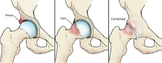 Femoroacetabular impingement diagram