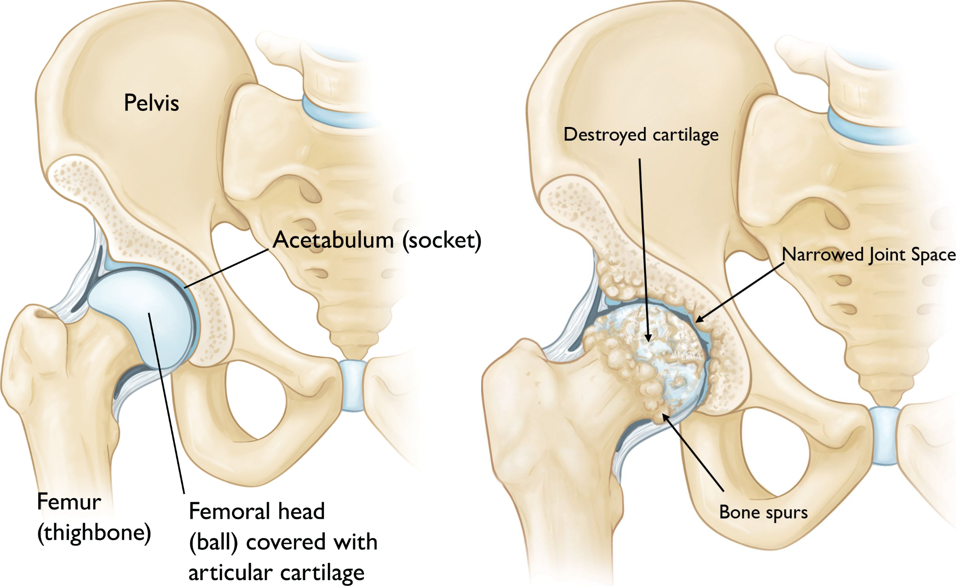 Healthy hip joint compared with an osteoarthritic hip showing destroyed cartilage, narrowed joint space, and bone spurs